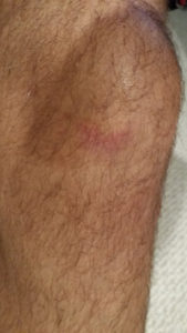 bruised knee christian lautenschleger